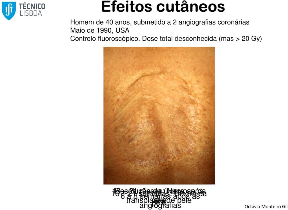 Dose total desconhecida (mas > 20 Gy) 16 18 Resolução 6 a 21 21 8