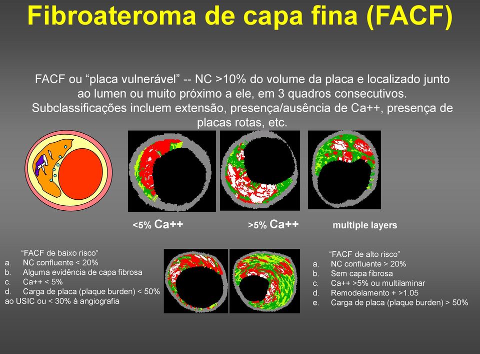 <5% Ca++ >5% Ca++ multiple layers FACF de baixo risco a. NC confluente < 20% b. Alguma evidência de capa fibrosa c. Ca++ < 5% d.
