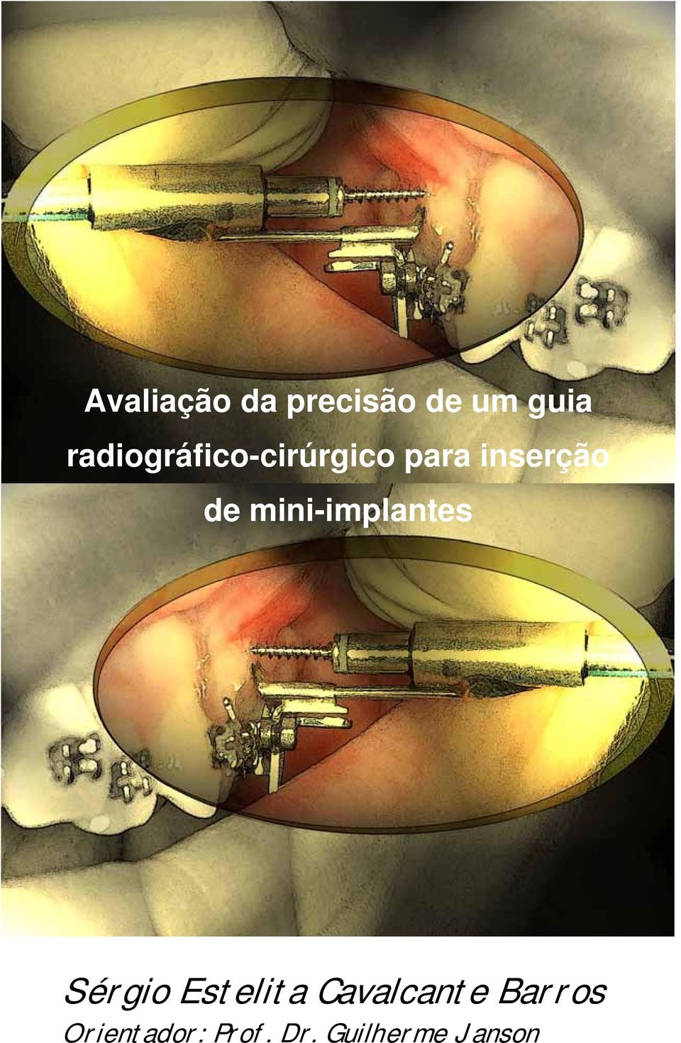 mini-implantes Sérgio Estelita