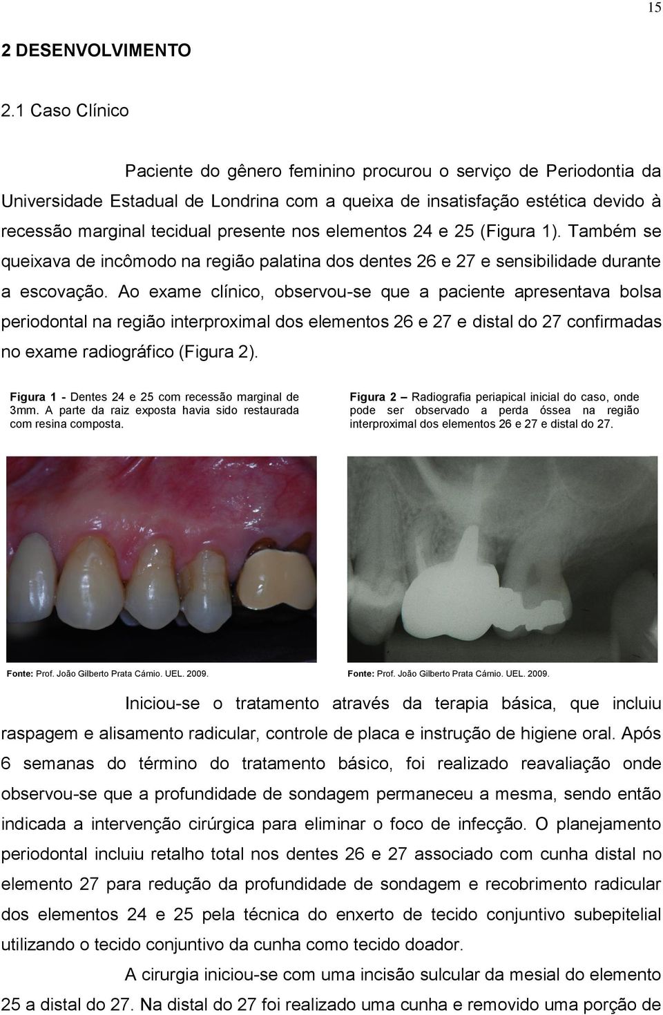 nos elementos 24 e 25 (Figura 1). Também se queixava de incômodo na região palatina dos dentes 26 e 27 e sensibilidade durante a escovação.