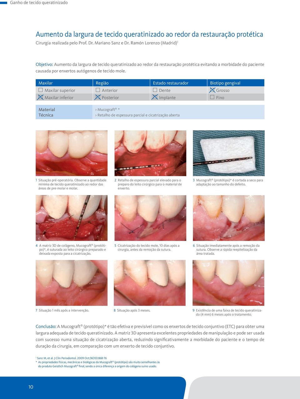 Maxilar Região Estado restaurador Biotipo gengival Maxilar superior Anterior Dente Grosso Maxilar inferior Posterior Implante Fino Material Técnica > Mucograft * > Retalho de espessura parcial e