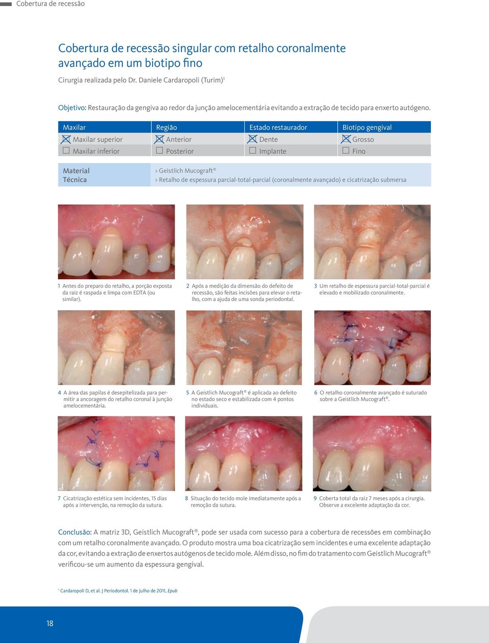 Maxilar Região Estado restaurador Biotipo gengival Maxilar superior Anterior Dente Grosso Maxilar inferior Posterior Implante Fino Material Técnica > Geistlich Mucograft > Retalho de espessura