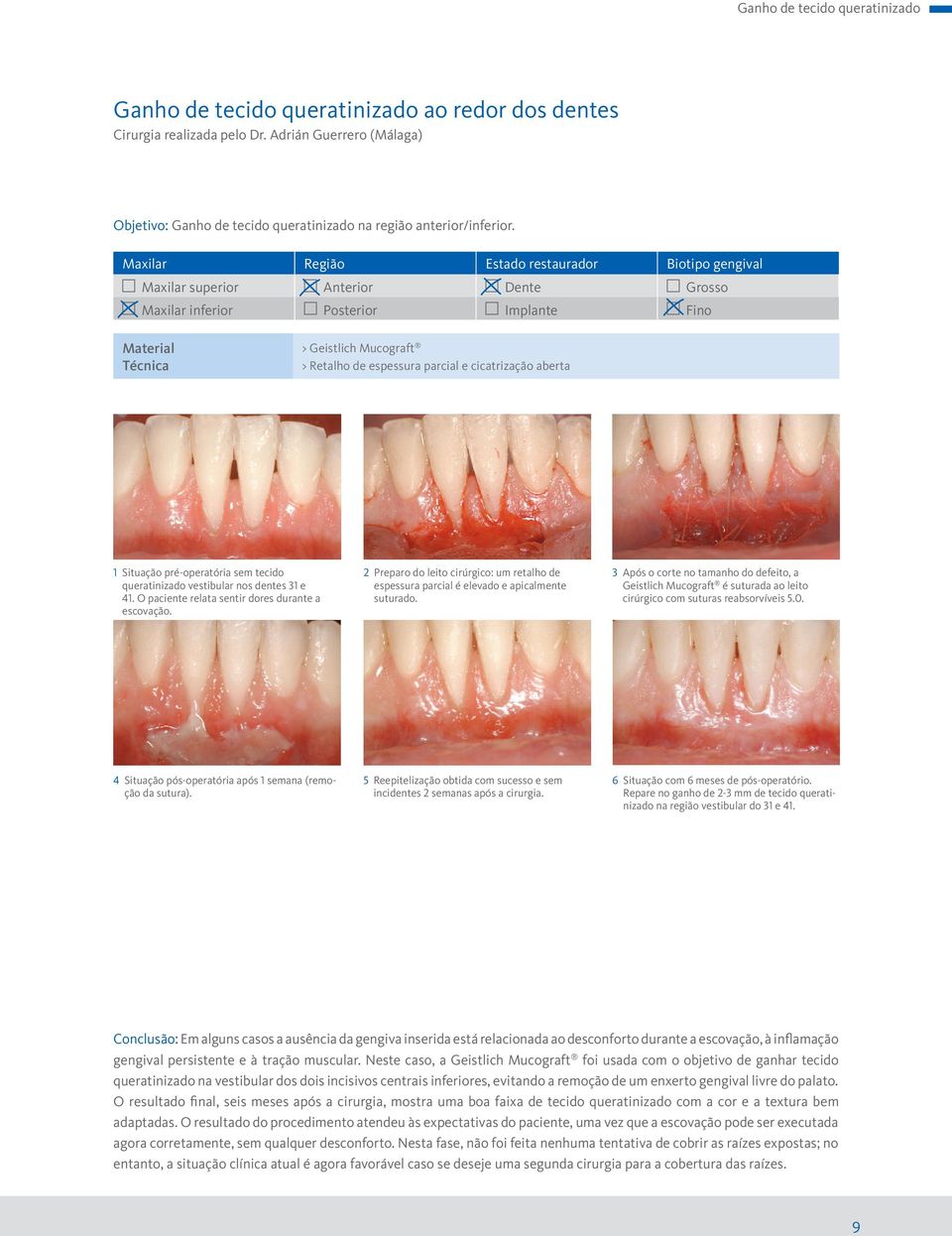 Maxilar Região Estado restaurador Biotipo gengival Maxilar superior Anterior Dente Grosso Maxilar inferior Posterior Implante Fino Material Técnica > Geistlich Mucograft > Retalho de espessura