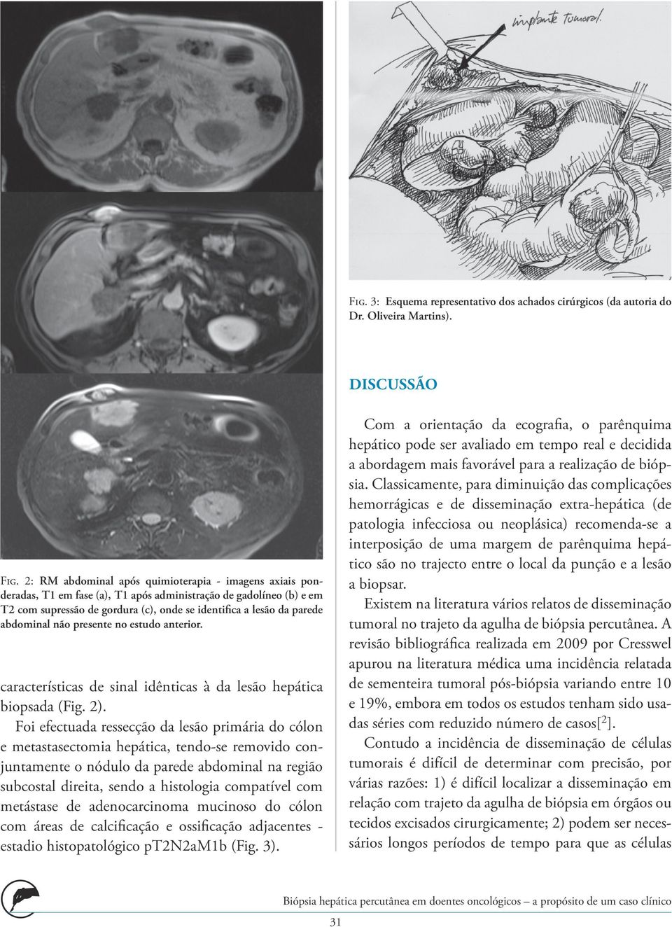 abdominal não presente no estudo anterior. características de sinal idênticas à da lesão hepática biopsada (Fig. 2).