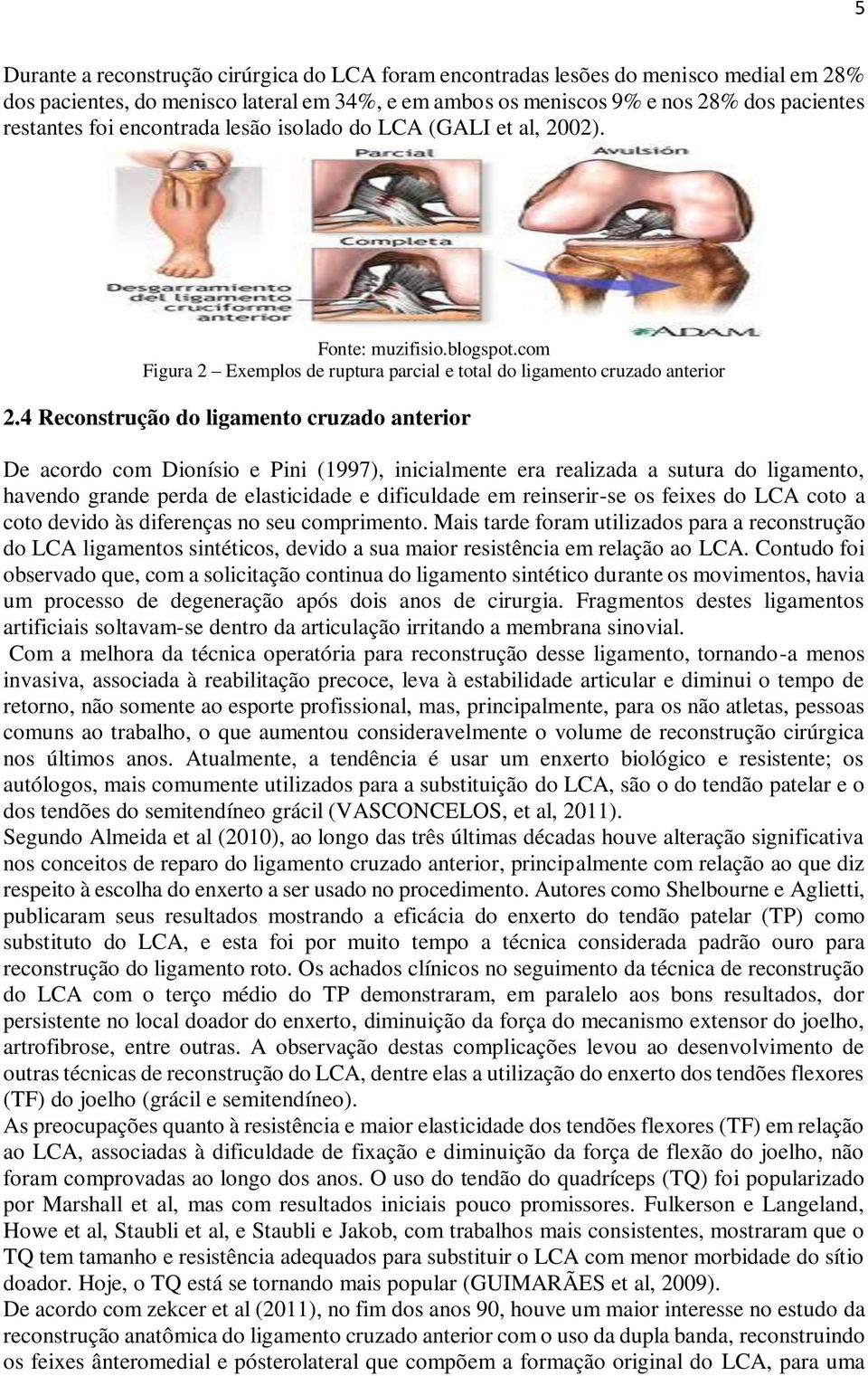 4 Reconstrução do ligamento cruzado anterior De acordo com Dionísio e Pini (1997), inicialmente era realizada a sutura do ligamento, havendo grande perda de elasticidade e dificuldade em reinserir-se