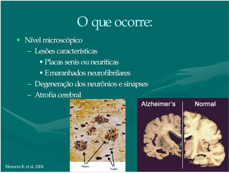 Emaranhados neurofibrilares Degeneração dos