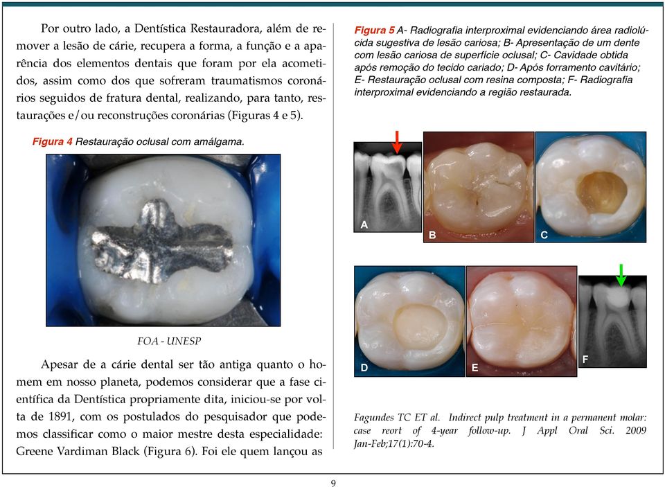 Figura 5 A- Radiografia interproximal evidenciando área radiolúcida sugestiva de lesão cariosa; B- Apresentação de um dente com lesão cariosa de superfície oclusal; C- Cavidade obtida após remoção do