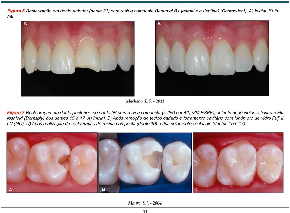 - 2011 Figura 7 Restauração em dente posterior no dente 26 com resina composta (Z 250 cor A2) (3M ESPE); selante de fóssulas e fissuras