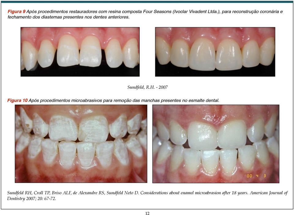 - 2007 Figura 10 Após procedimentos microabrasivos para remoção das manchas presentes no esmalte dental.