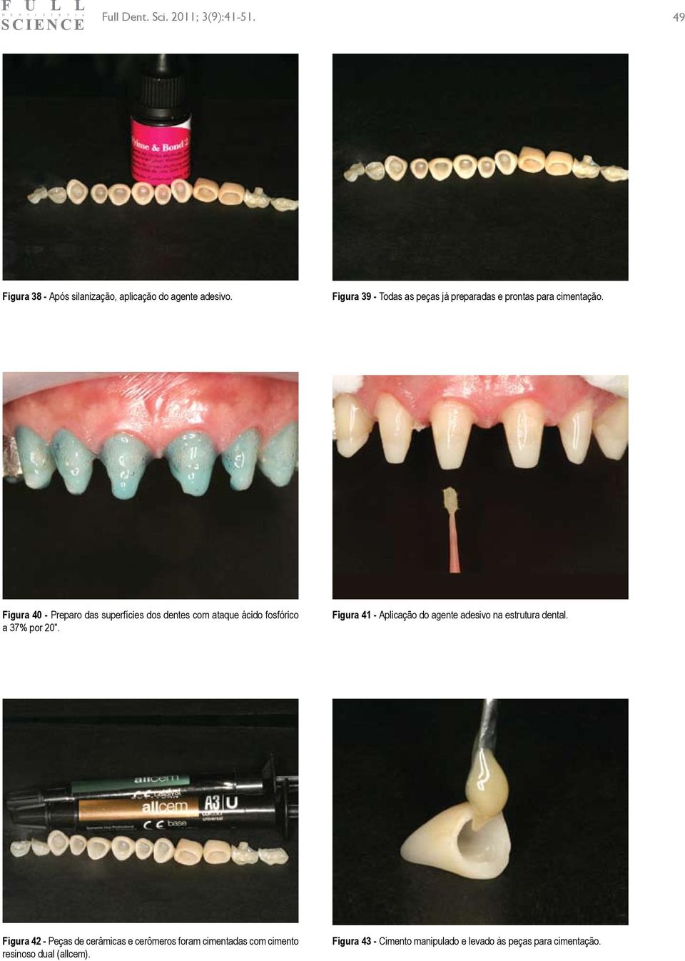 Figura 40 - Preparo das superfícies dos dentes com ataque ácido fosfórico a 37% por 20.