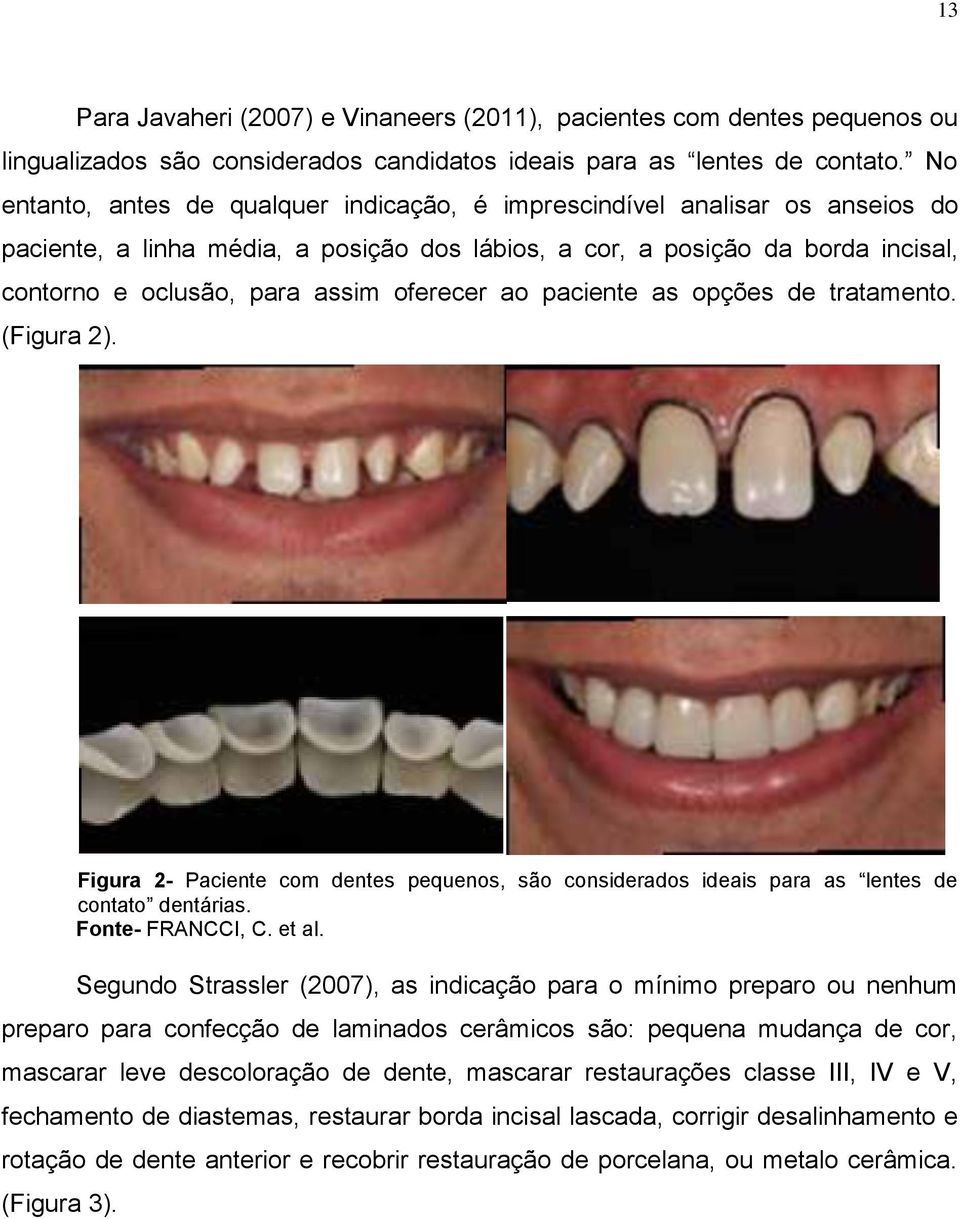 oferecer ao paciente as opções de tratamento. (Figura 2). Figura 2- Paciente com dentes pequenos, são considerados ideais para as lentes de contato dentárias. Fonte- FRANCCI, C. et al.