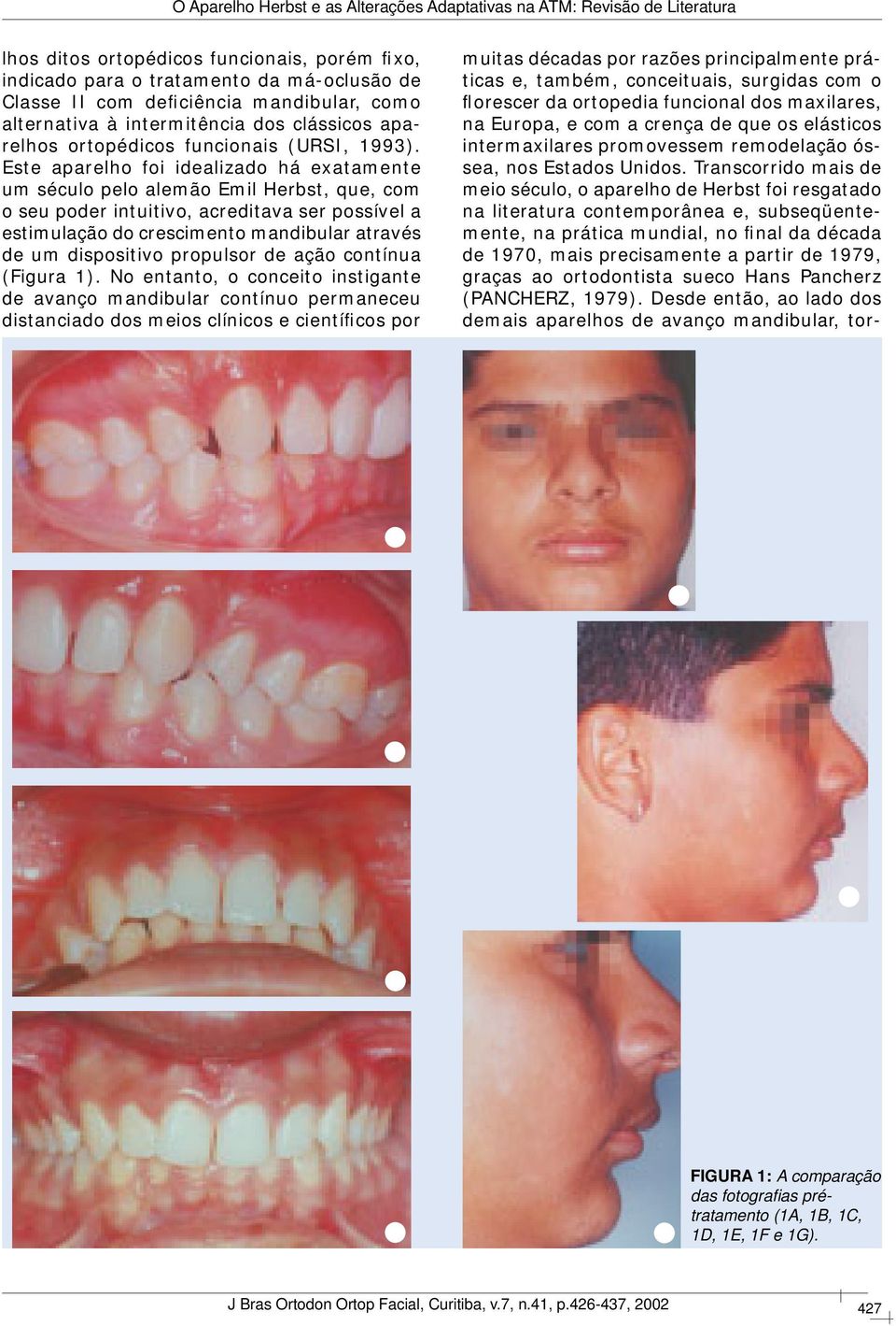 Este aparelho foi idealizado há exatamente um século pelo alemão Emil Herbst, que, com o seu poder intuitivo, acreditava ser possível a estimulação do crescimento mandibular através de um dispositivo