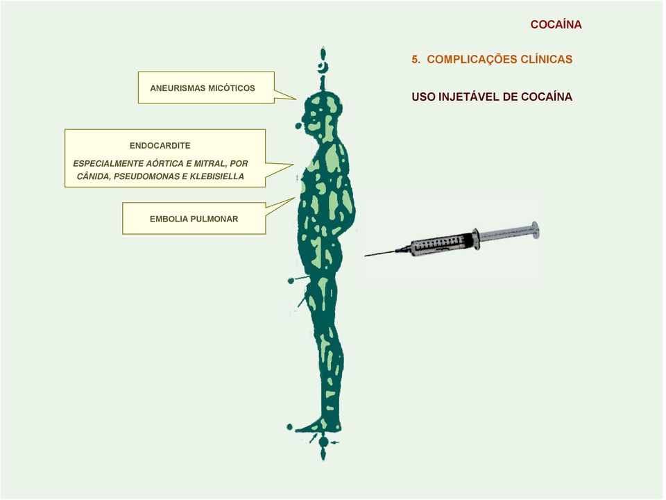 USO INJETÁVEL DE COCAÍNA ENDOCARDITE