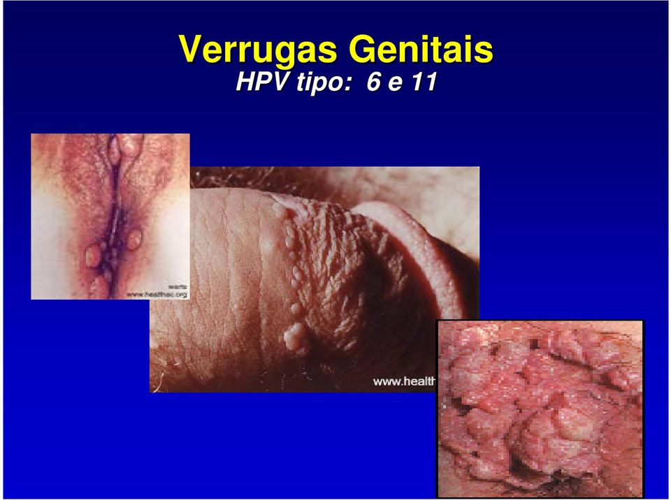 HPV tipo: