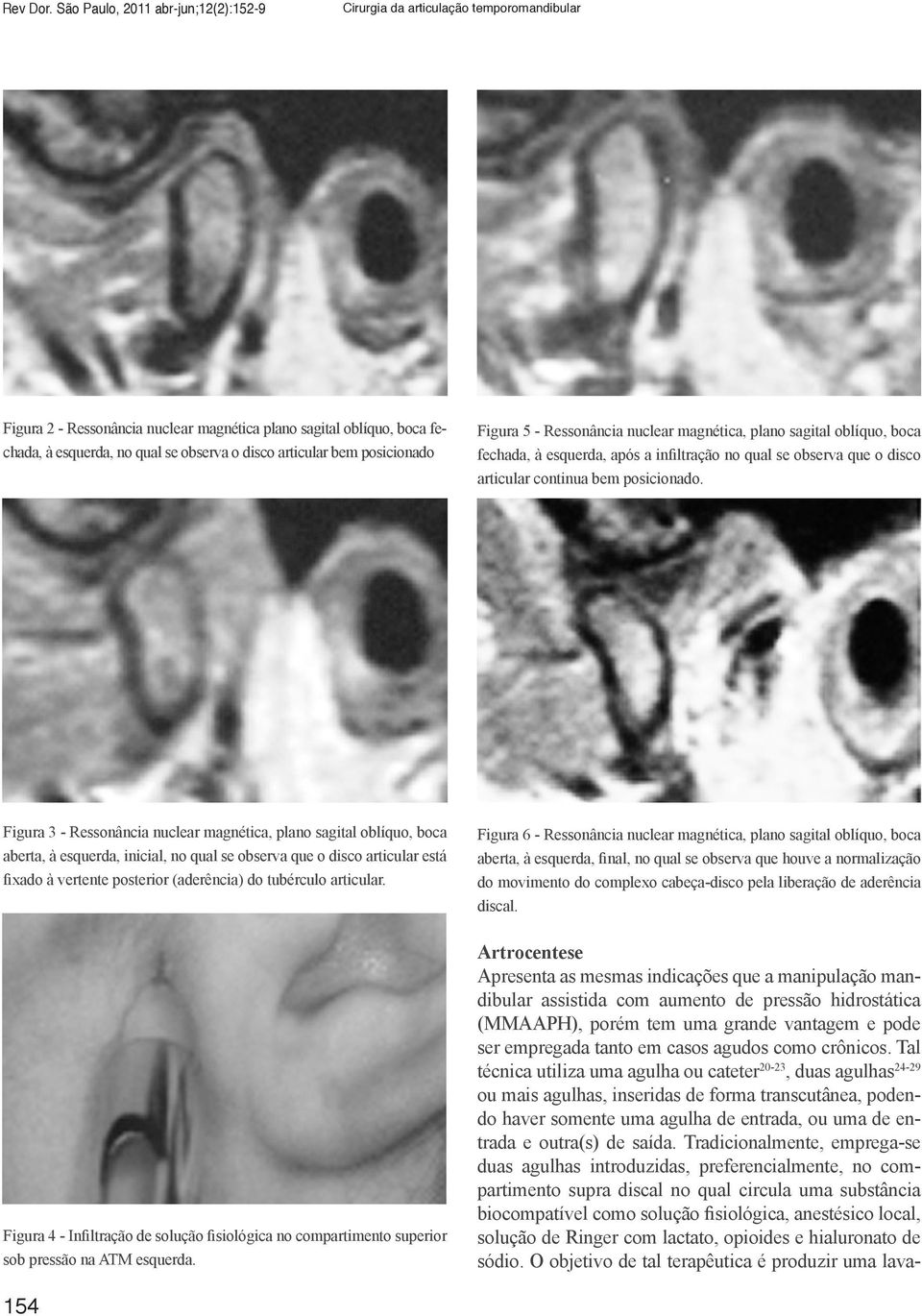 articular bem posicionado Figura 5 - Ressonância nuclear magnética, plano sagital oblíquo, boca fechada, à esquerda, após a infiltração no qual se observa que o disco articular continua bem