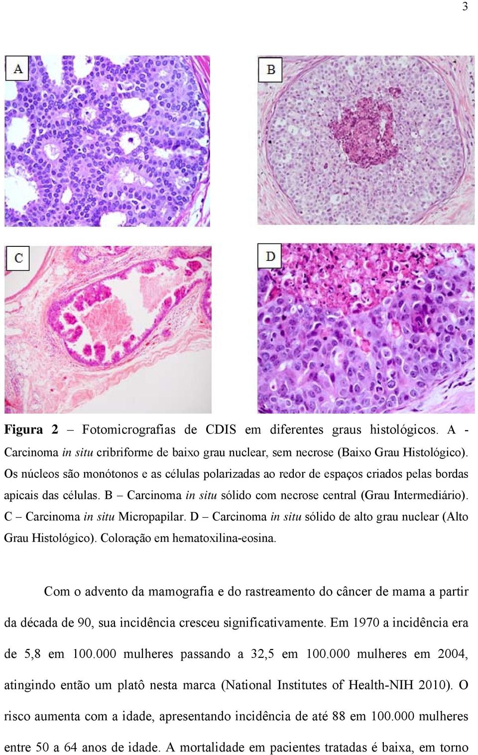 C Carcinoma in situ Micropapilar. D Carcinoma in situ sólido de alto grau nuclear (Alto Grau Histológico). Coloração em hematoxilina-eosina.