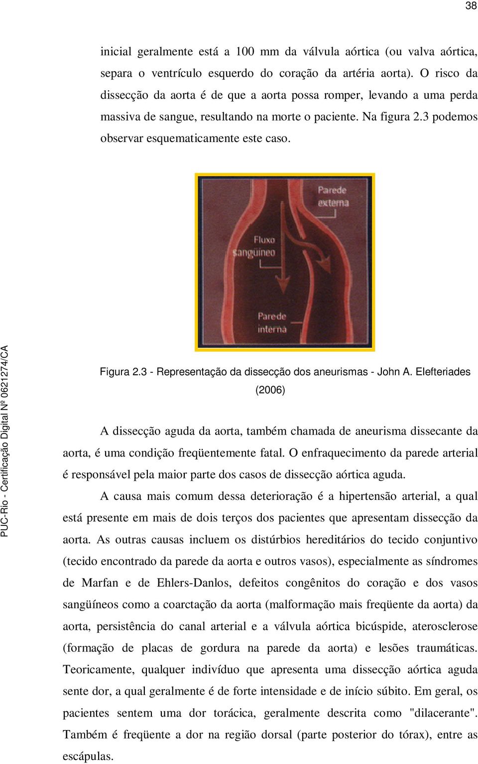 3 - Representação da dissecção dos aneurismas - John A. Elefteriades (2006) A dissecção aguda da aorta, também chamada de aneurisma dissecante da aorta, é uma condição freqüentemente fatal.