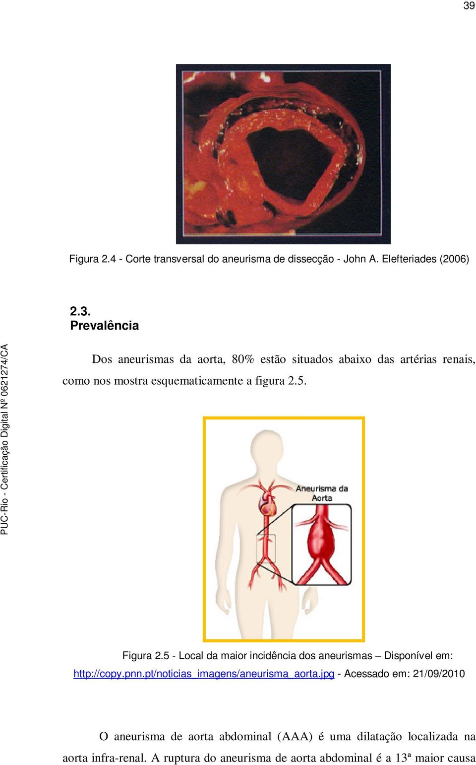 jpg - Acessado em: 21/09/2010 O aneurisma de aorta abdominal (AAA) é uma dilatação localizada na aorta infra-renal.