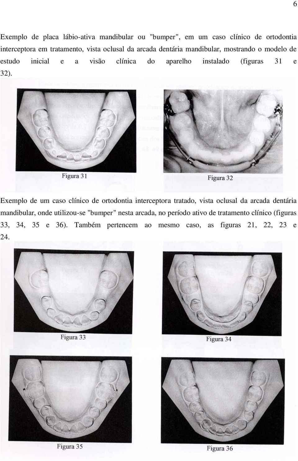 Exemplo de um caso clínico de ortodontia interceptora tratado, vista oclusal da arcada dentária mandibular, onde utilizou-se