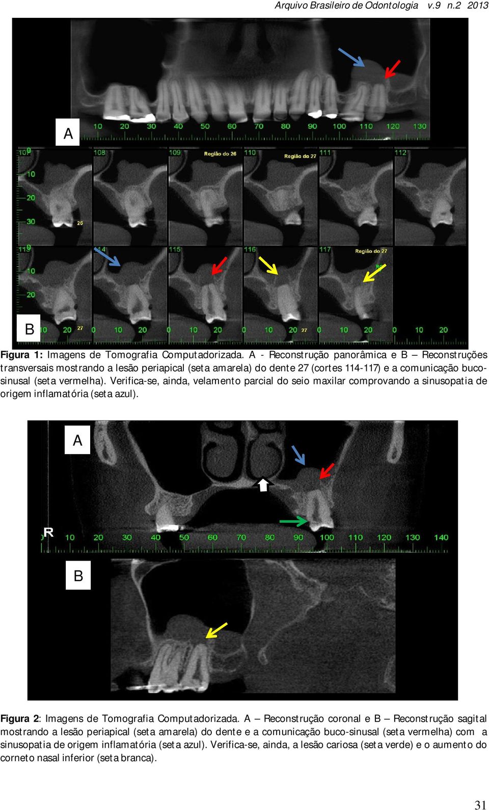 Verifica-se, ainda, velamento parcial do seio maxilar comprovando a sinusopatia de origem inflamatória (seta azul). A B Figura 2: Imagens de Tomografia Computadorizada.