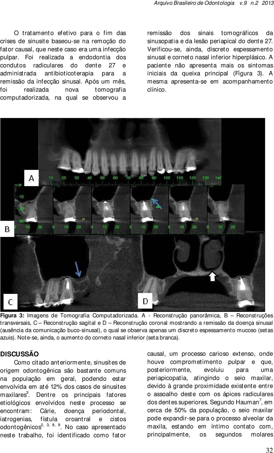 Após um mês, foi realizada nova tomografia computadorizada, na qual se observou a remissão dos sinais tomográficos da sinusopatia e da lesão periapical do dente 27.