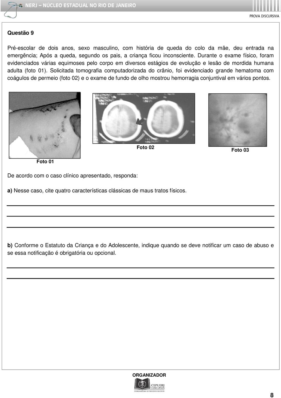 Solicitada tomografia computadorizada do crânio, foi evidenciado grande hematoma com coágulos de permeio (foto 02) e o exame de fundo de olho mostrou hemorragia conjuntival em vários pontos.