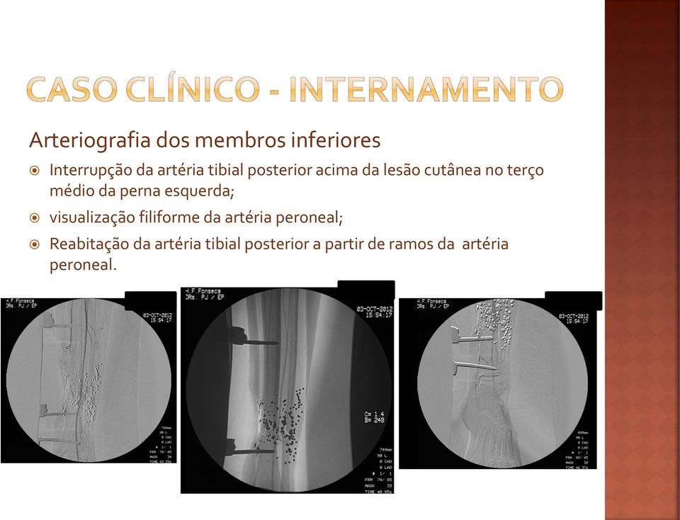 esquerda; visualização filiforme da artéria peroneal;