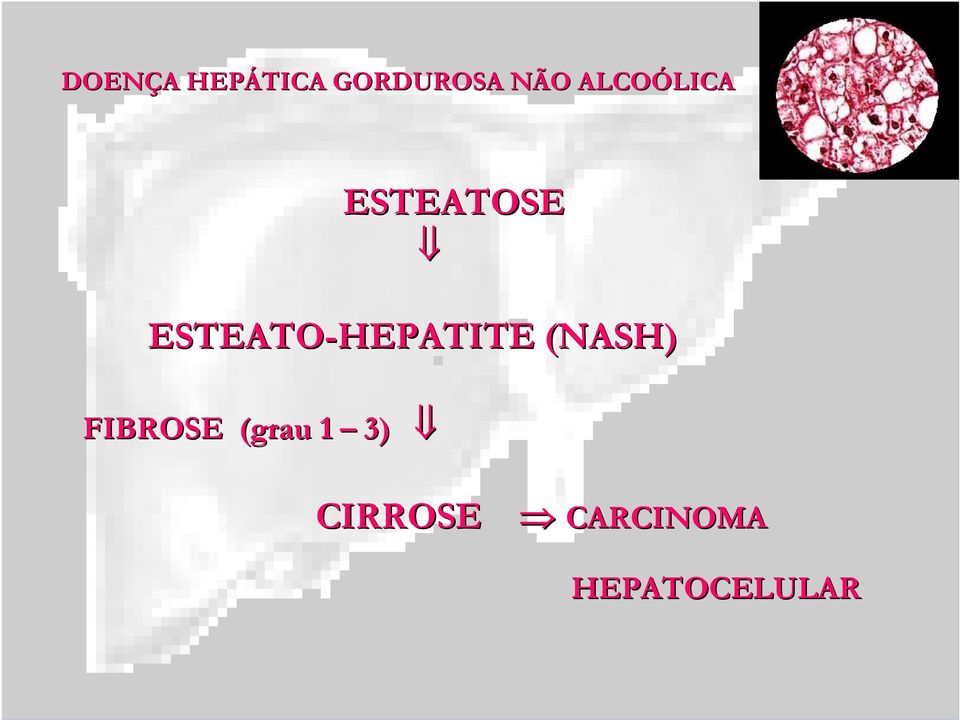 ESTEATO-HEPATITE (NASH)