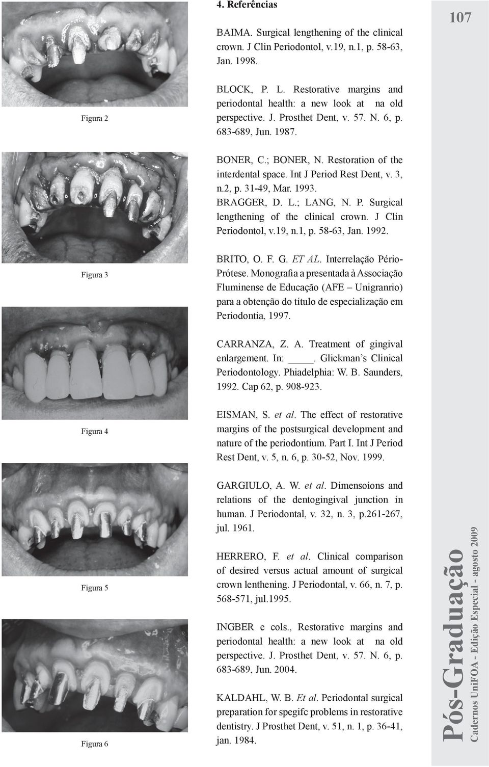 Int J Period Rest Dent, v. 3, n.2, p. 31-49, Mar. 1993. BRAGGER, D. L.; LANG, N. P. Surgical lengthening of the clinical crown. J Clin Periodontol, v.19, n.1, p. 58-63, Jan. 1992. Figura 3 BRITO, O.