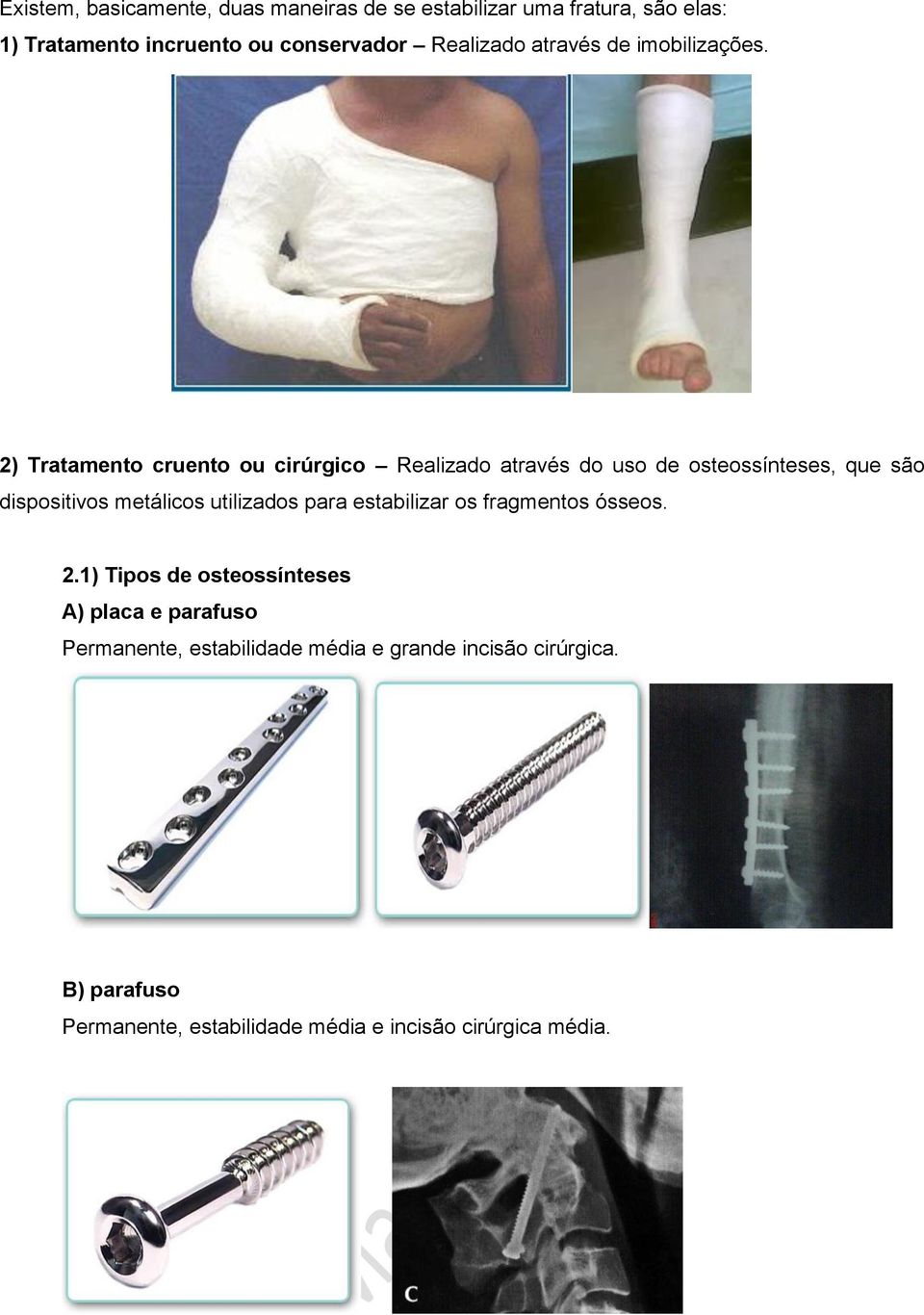 2) Tratamento cruento ou cirúrgico Realizado através do uso de osteossínteses, que são dispositivos metálicos utilizados