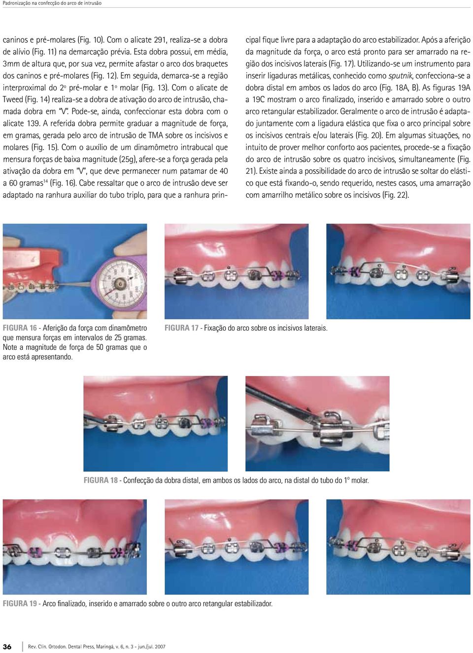 Em seguida, demarca-se a região interproximal do 2º pré-molar e 1º molar (Fig. 13). Com o alicate de Tweed (Fig. 14) realiza-se a dobra de ativação do arco de intrusão, chamada dobra em V.