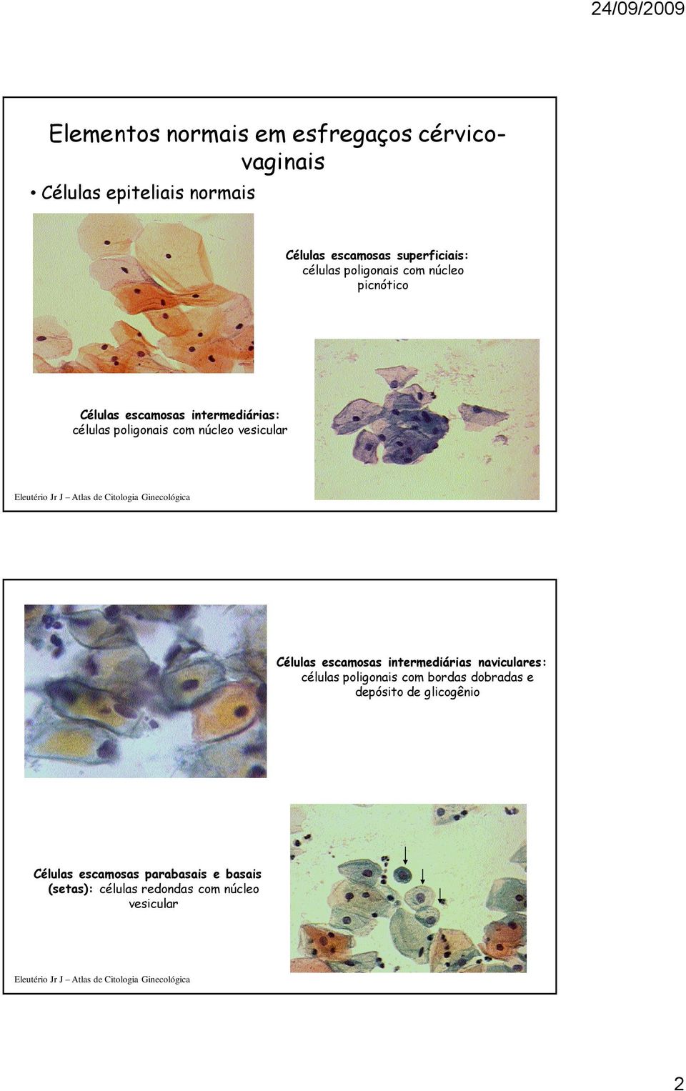 poligonais com núcleo vesicular Células escamosas intermediárias naviculares: células poligonais com