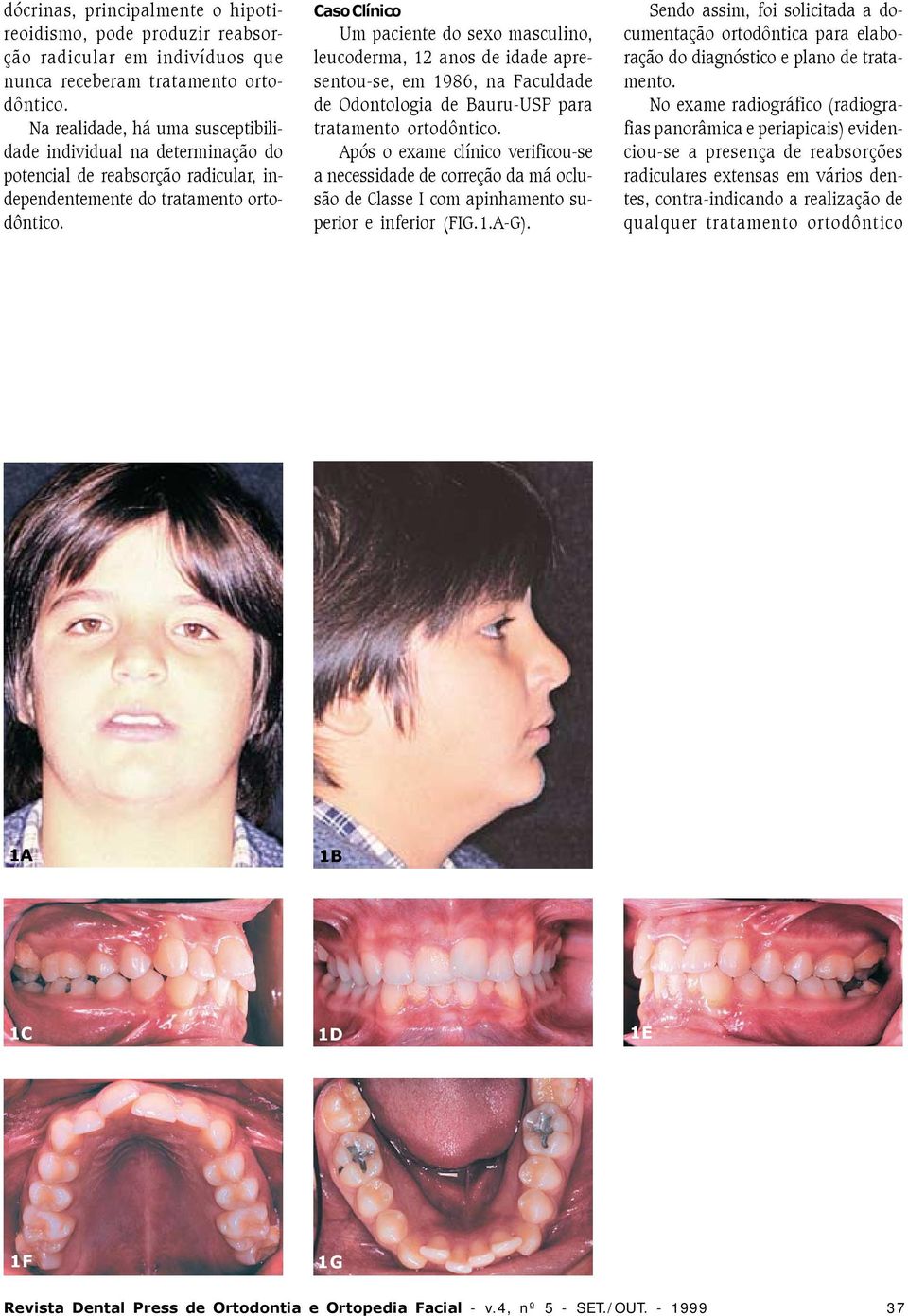 Caso Clínico Um paciente do sexo masculino, leucoderma, 12 anos de idade apresentou-se, em 1986, na Faculdade de Odontologia de Bauru-USP para tratamento ortodôntico.