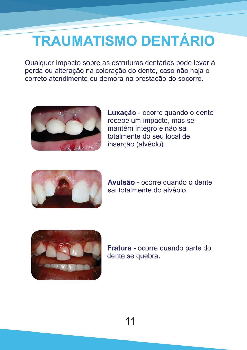 Luxação - ocorre quando o dente recebe um impacto, mas se mantém íntegro e não sai totalmente do seu local