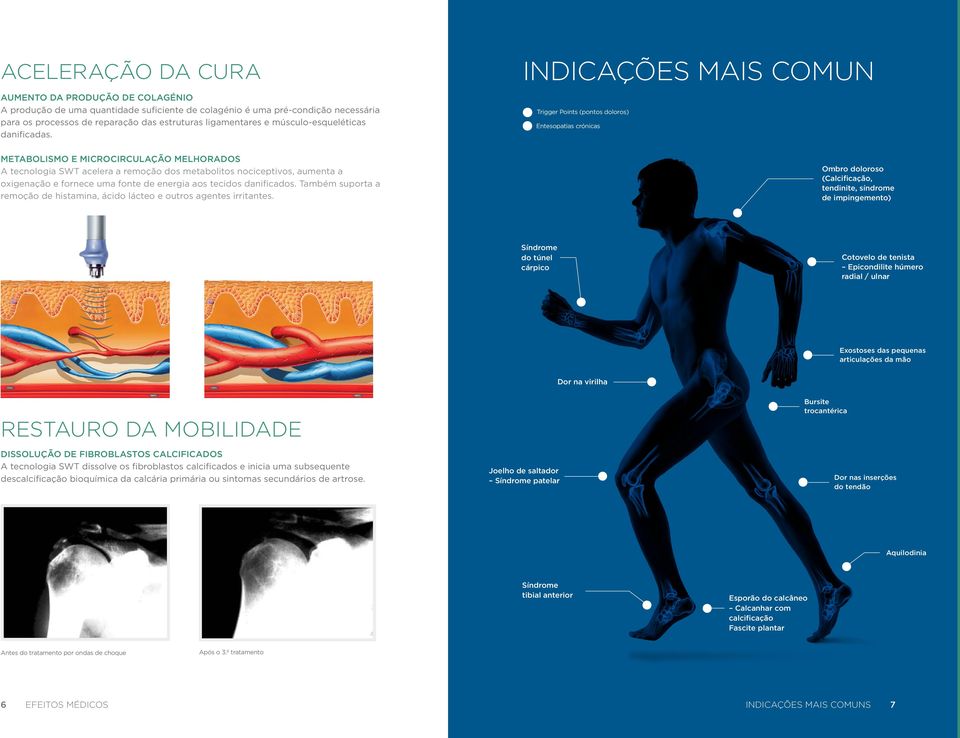 INDICAÇÕES MAIS COMUN Trigger Points (pontos doloros) Entesopatias crónicas METABOLISMO E MICROCIRCULAÇÃO MELHORADOS A tecnologia SWT acelera a remoção dos metabolitos nociceptivos, aumenta a