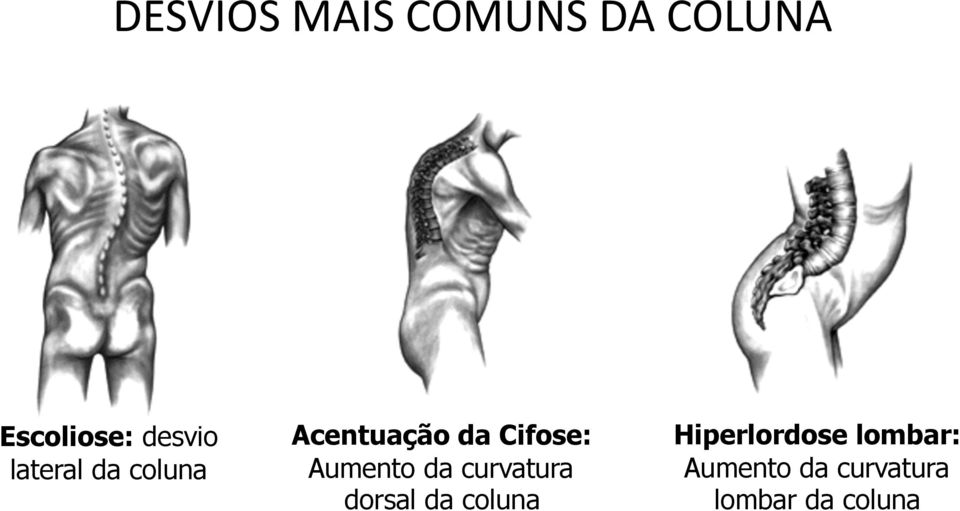 Cifose: Aumento da curvatura dorsal da coluna