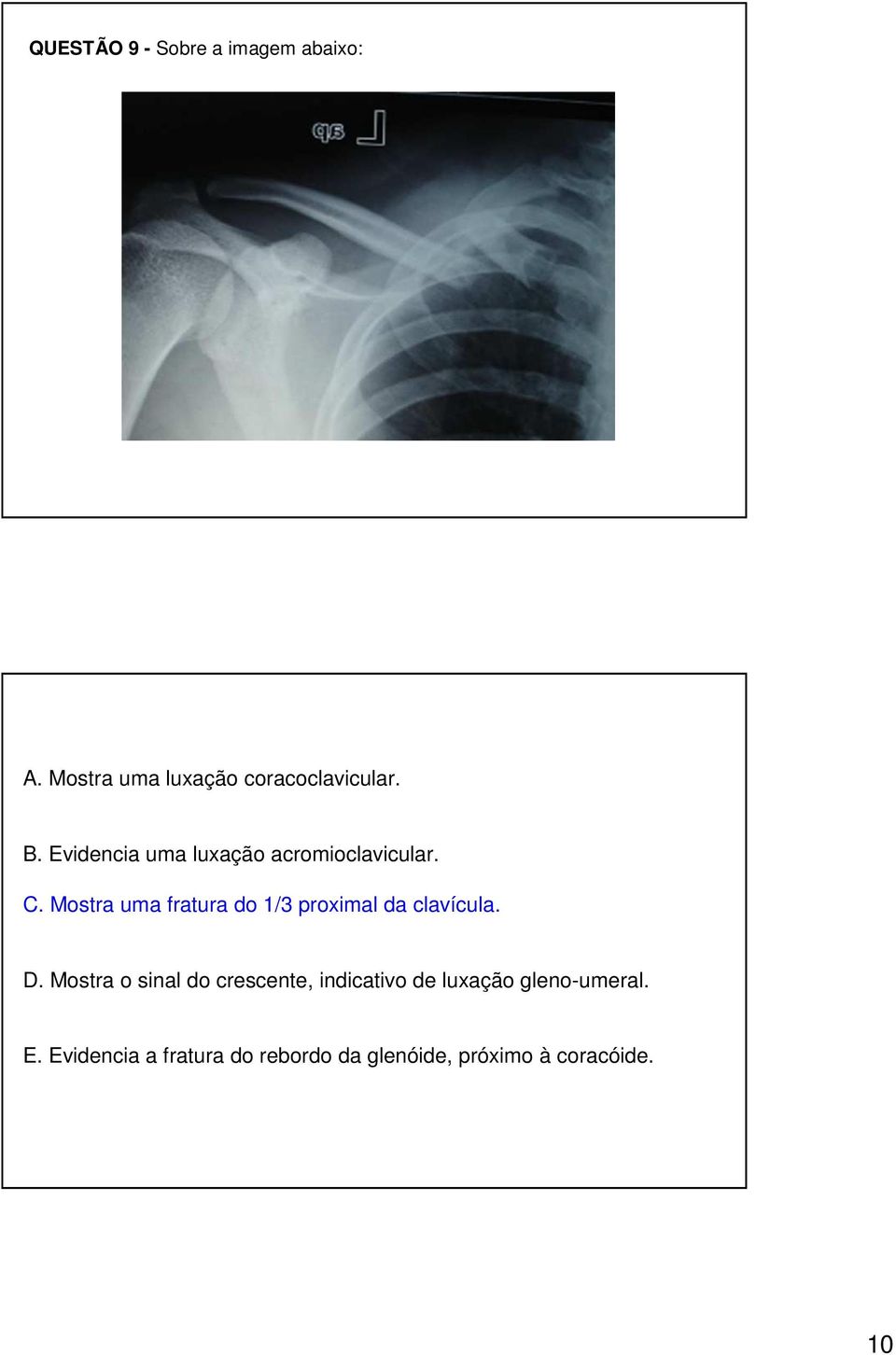 Mostra uma fratura do 1/3 proximal da clavícula. D.