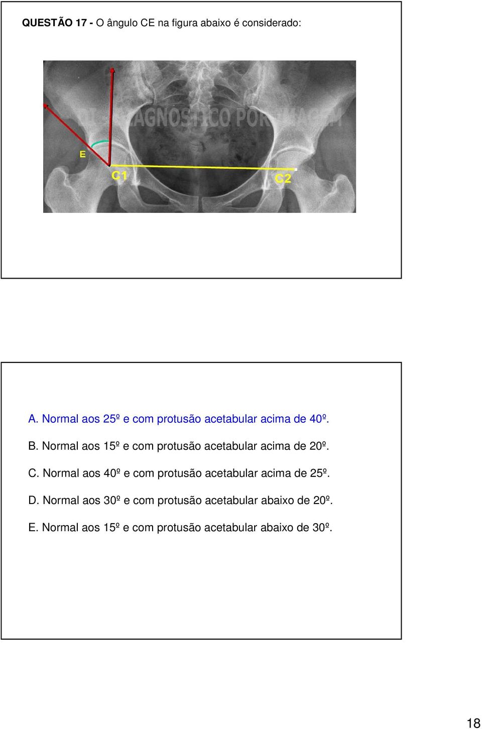 Normal aos 15º e com protusão acetabular acima de 20º. C.