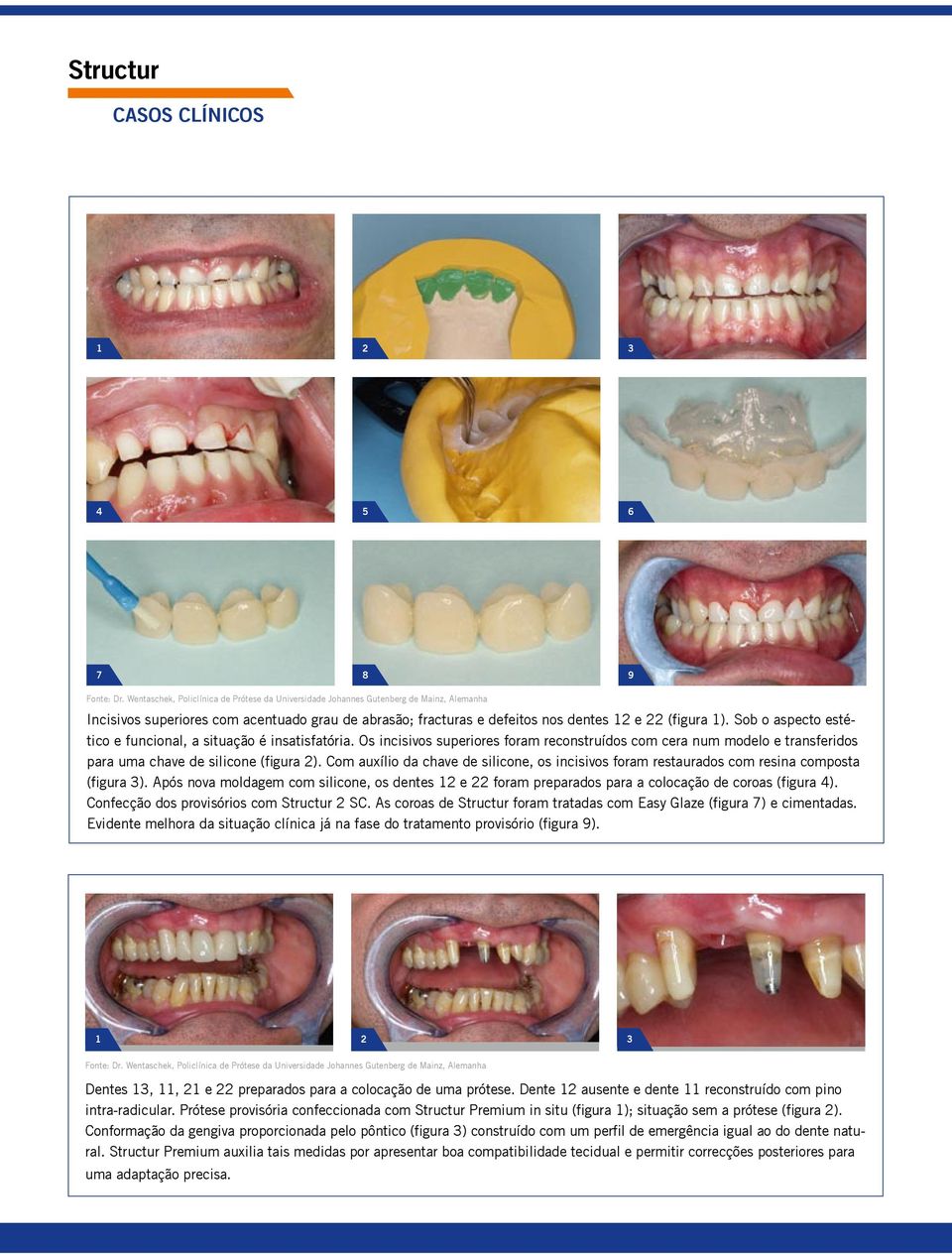 Sob o aspecto estético e funcional, a situação é insatisfatória. Os incisivos superiores foram reconstruídos com cera num modelo e transferidos para uma chave de silicone (figura 2).