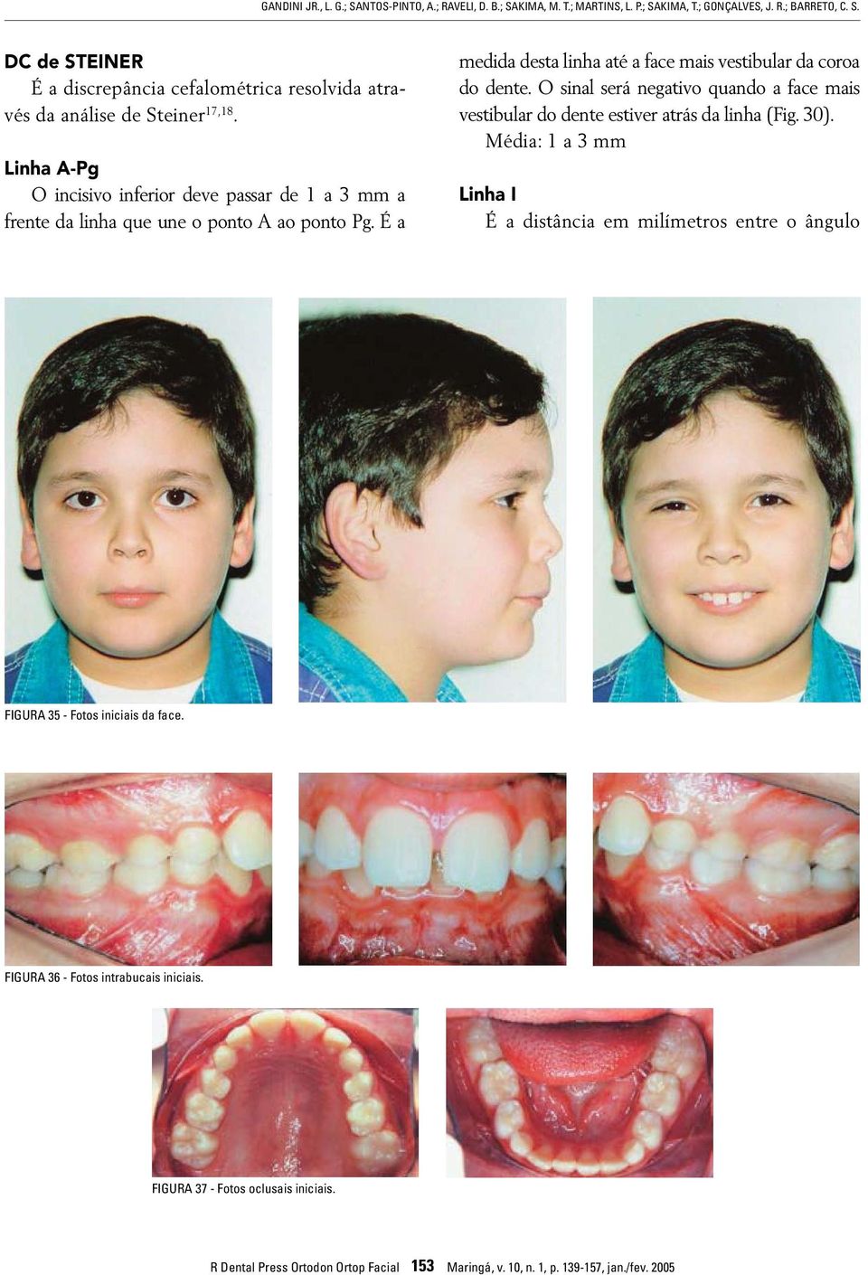 O sinal será negativo quando a face mais vestibular do dente estiver atrás da linha (Fig. 30).