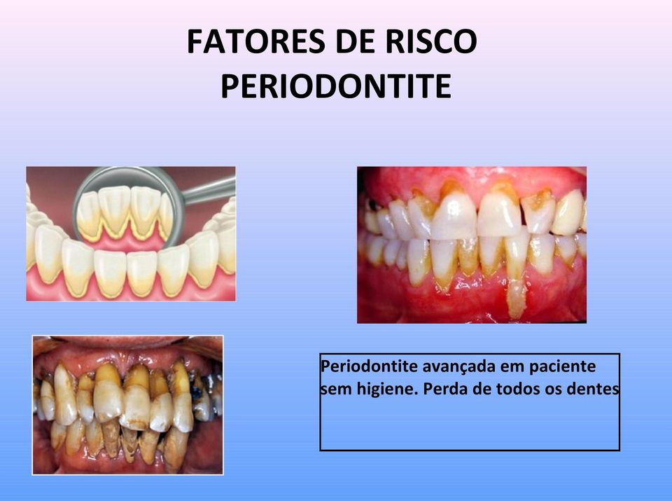 avançada em paciente sem