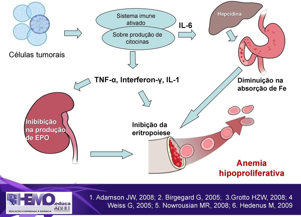 Inibição da eritropoiese Anemia hipoproliferativa 1. Adamson JW, 2008; 2.