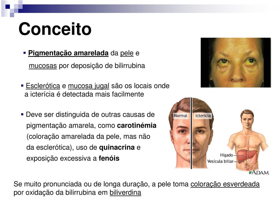 como carotinémia (coloração amarelada da pele, mas não da esclerótica), uso de quinacrina e exposição excessiva a