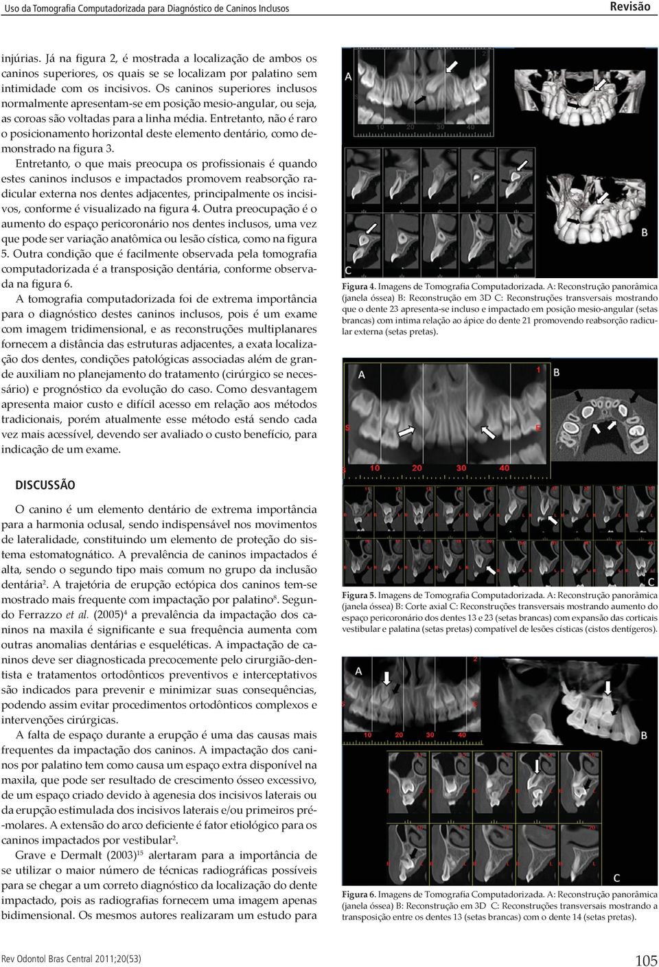 Entretanto, não é raro o posicionamento horizontal deste elemento dentário, como demonstrado na figura 3.