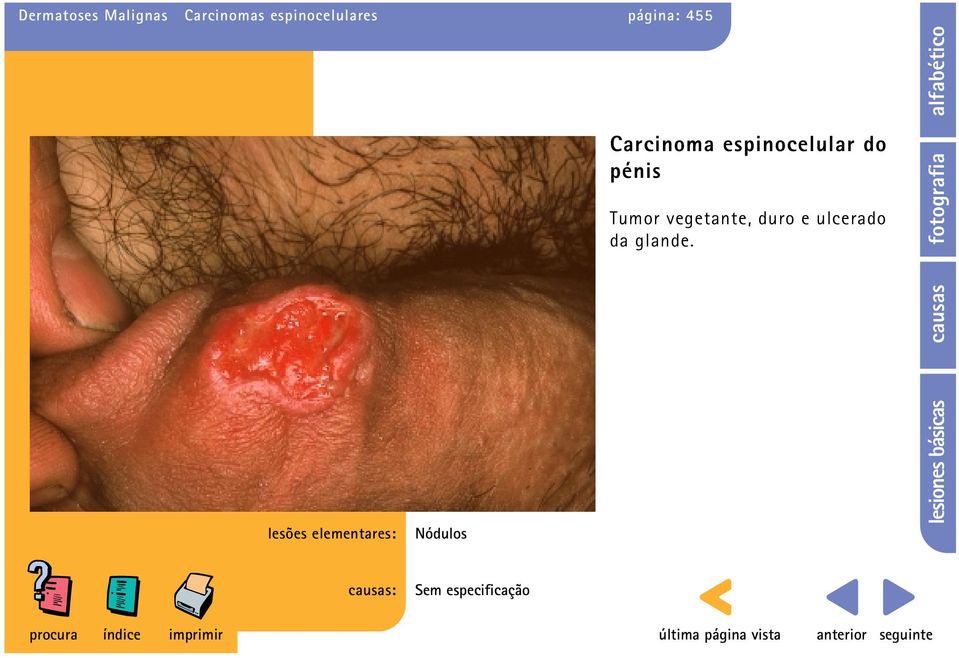 Carcinoma espinocelular do pénis