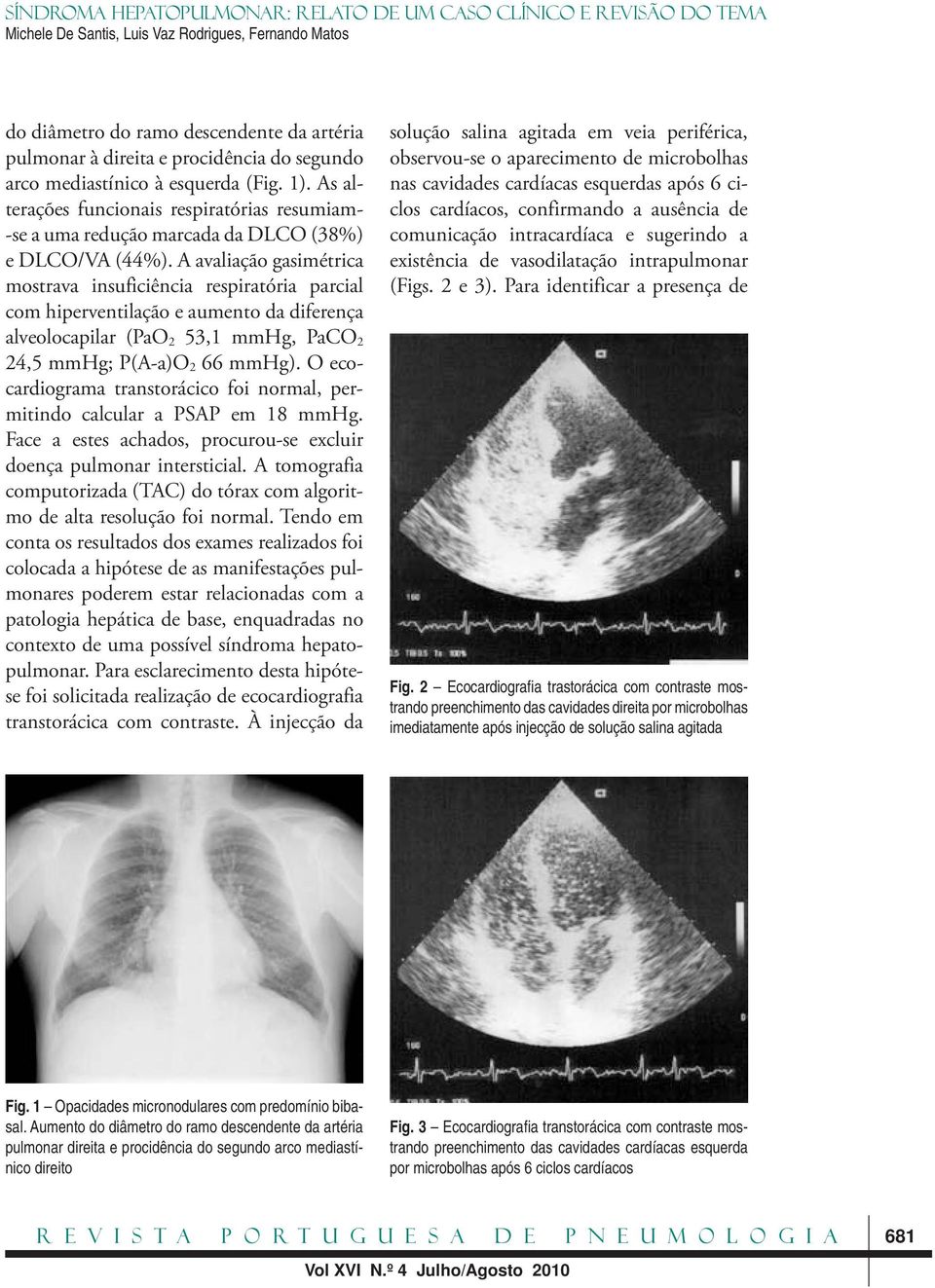 A avaliação gasimétrica mostrava insuficiência respiratória parcial com hiperventilação e aumento da diferença alveolocapilar (PaO 2 53,1 mmhg, PaCO 2 24,5 mmhg; P(A -a)o 2 66 mmhg).