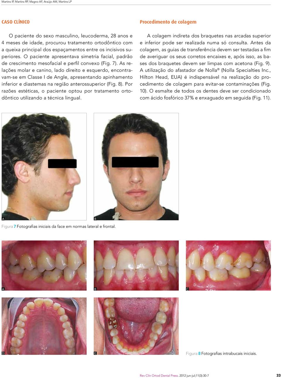 s relações molar e canino, lado direito e esquerdo, encontravam-se em Classe I de ngle, apresentando apinhamento inferior e diastemas na região anterossuperior (Fig. 8).