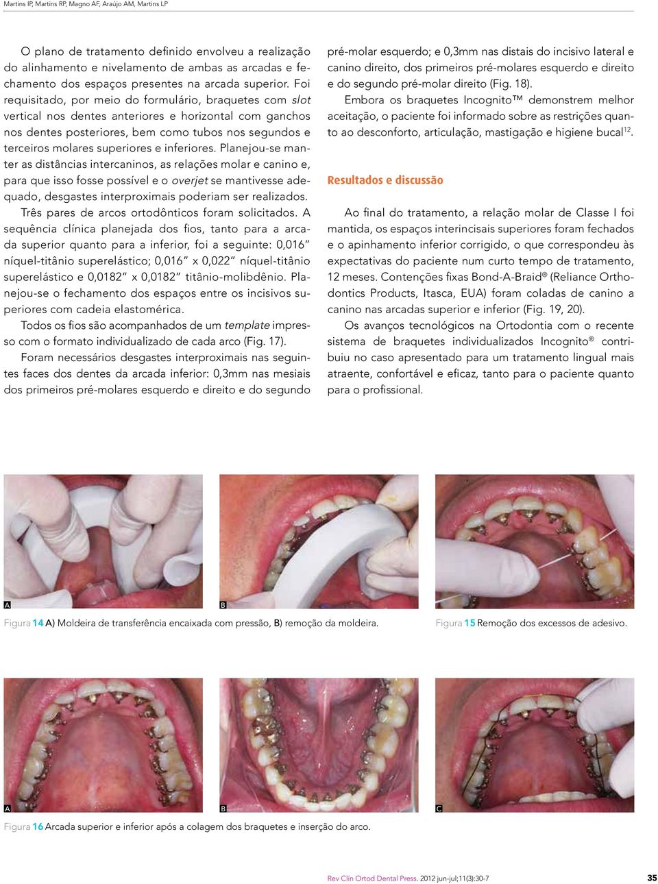 Foi requisitado, por meio do formulário, braquetes com slot vertical nos dentes anteriores e horizontal com ganchos nos dentes posteriores, bem como tubos nos segundos e terceiros molares superiores