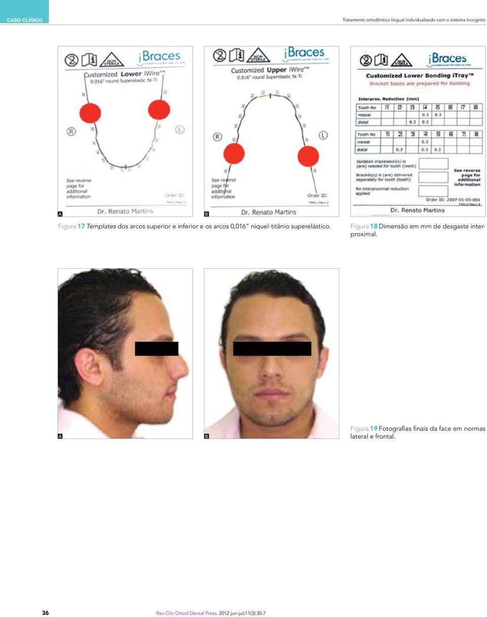 superelástico. Figura 18 Dimensão em mm de desgaste interproximal.