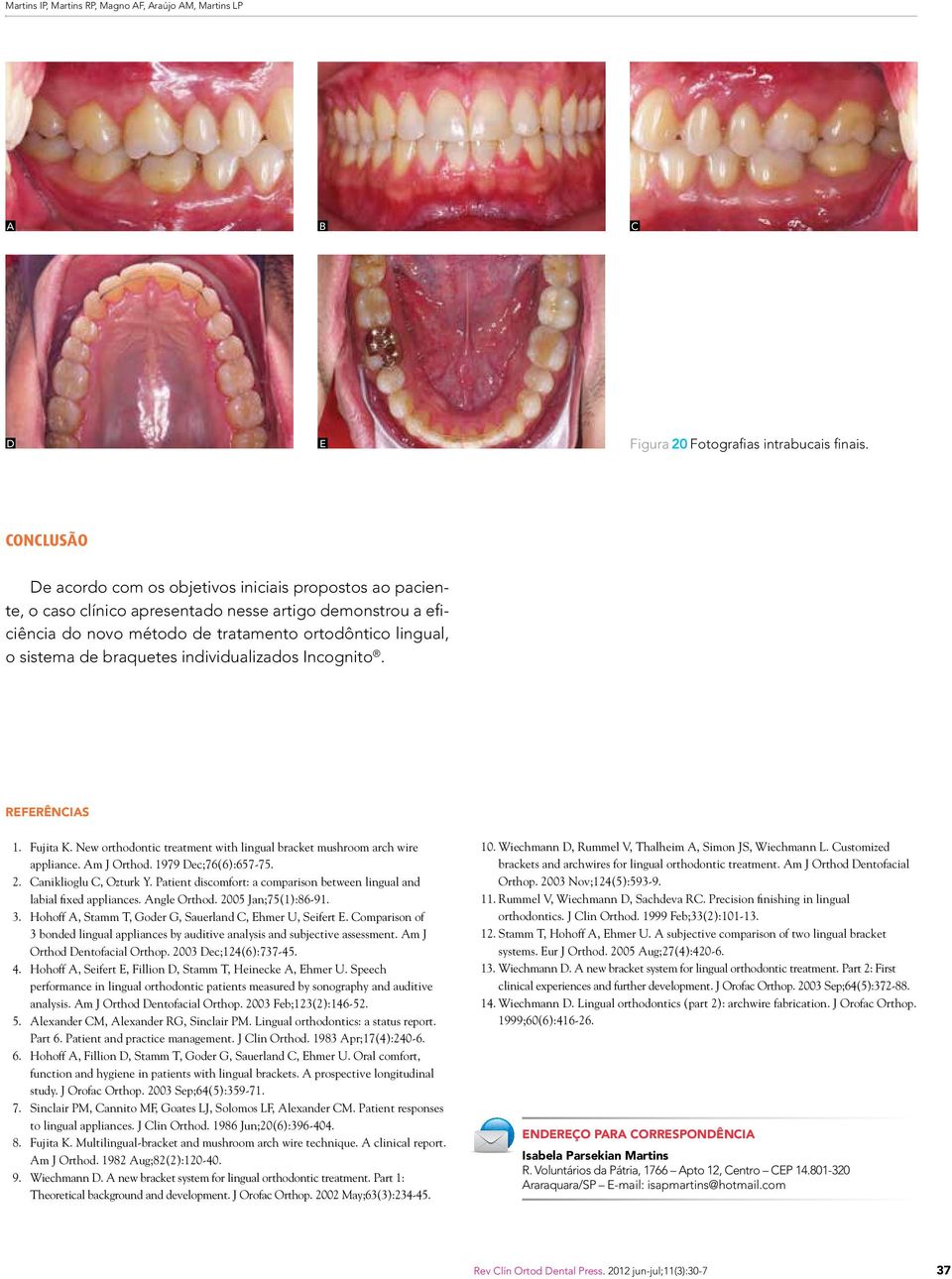 braquetes individualizados Incognito. Referências 1. Fujita K. New orthodontic treatment with lingual bracket mushroom arch wire appliance. m J Orthod. 1979 Dec;76(6):657-75. 2.